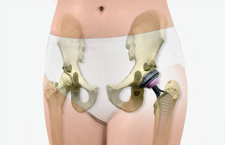 Prothèse totale de hanche - Chirurgie Orthopédique Versailles